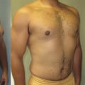 Understanding Gynecomastia Surgery: What You Need to Know