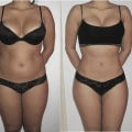 Understanding Liposuction Results