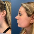 Understanding Rhinoplasty Results: What You Need to Know