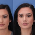 Unique Physical Differences in Female Patients: What You Need to Know Before Undergoing Plastic Surgery