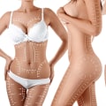 All You Need to Know About Liposuction