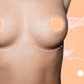 Covering all about Breast Augmentation Results: What You Need to Know