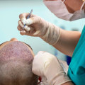 Understanding Hair Transplant Surgery