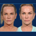 Understanding Facelift: Types, Risks, and Recovery