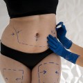 All About Tummy Tuck Surgery: A Comprehensive Guide for Women