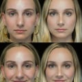 A Complete Guide to Rhinoplasty: Everything You Need to Know