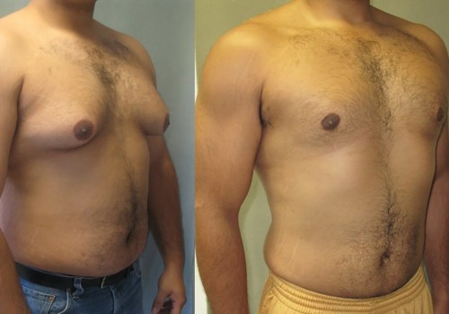 Understanding Gynecomastia Surgery: What You Need to Know