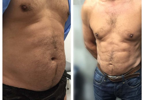 Everything You Need to Know About Liposuction for Men