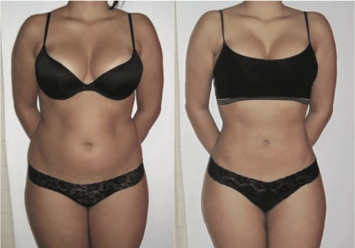 Understanding Liposuction Results