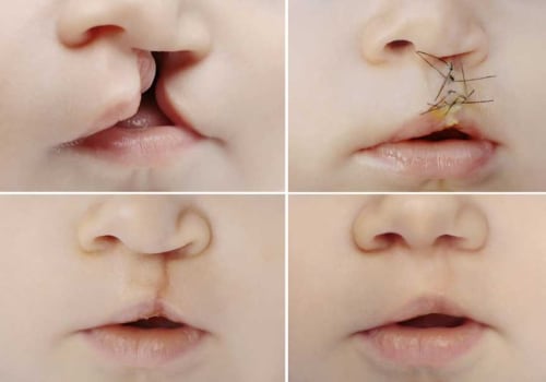 Understanding Cleft Lip/Palate Repair