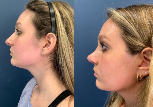 Understanding Rhinoplasty Results: What You Need to Know