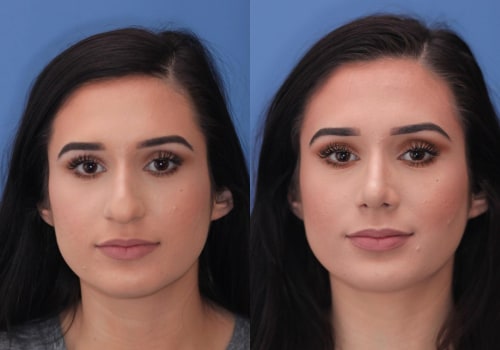 Unique Physical Differences in Female Patients: What You Need to Know Before Undergoing Plastic Surgery