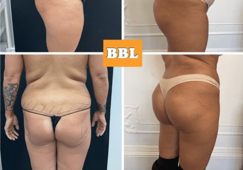 All You Need to Know About Brazilian Butt Lifts