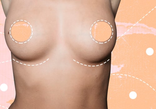 Covering all about Breast Augmentation Results: What You Need to Know