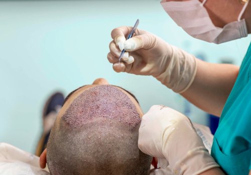 Understanding Hair Transplant Surgery