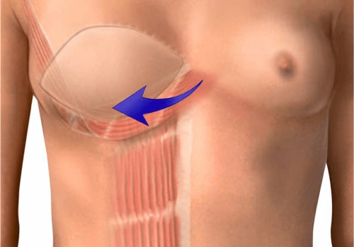 Breast Reconstruction: What You Need to Know