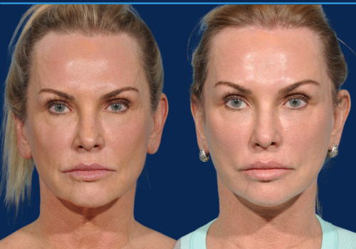 Understanding Facelift: Types, Risks, and Recovery