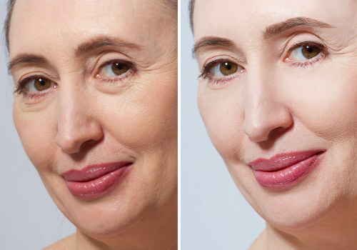 All You Need to Know About Facelift Results