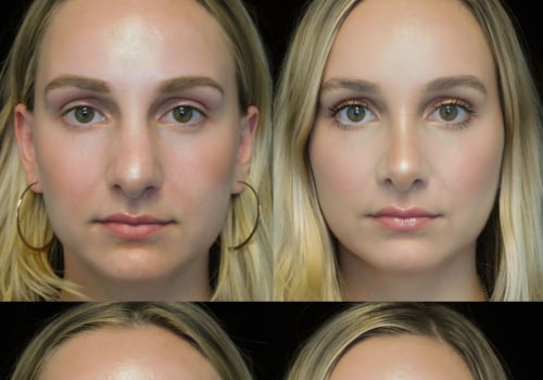 A Complete Guide to Rhinoplasty: Everything You Need to Know